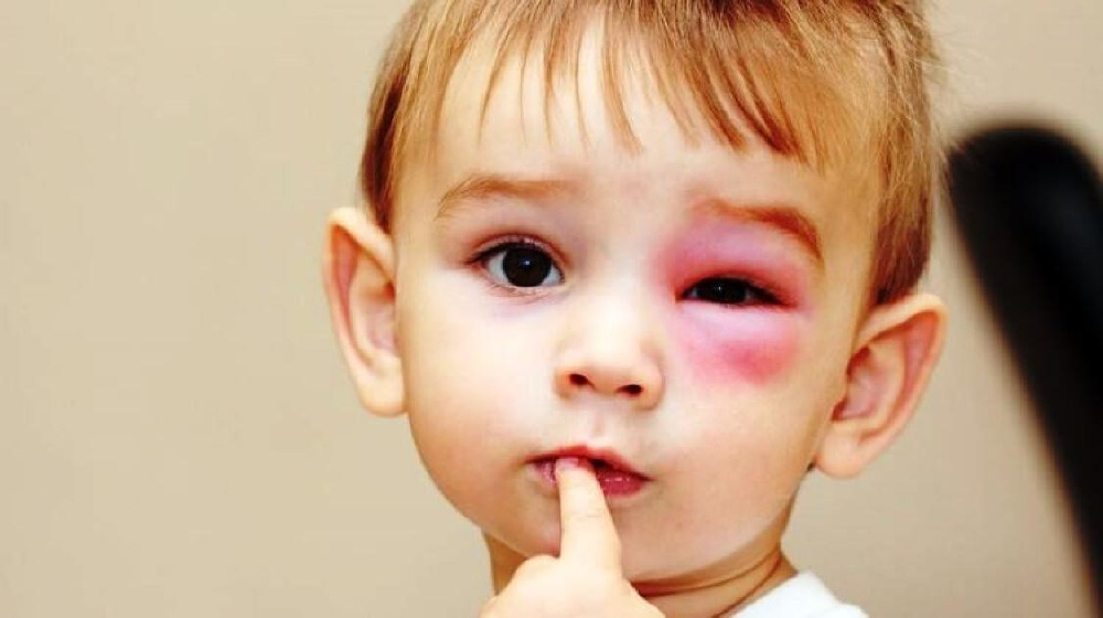 Bug Bites on the Eyelid